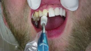 Veneers Dental Procedure at Cosmetic Dental Associates in San Antonio TX [upl. by Idorb]