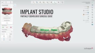 3shape Implant Studio Partially Edentulous [upl. by Corliss840]