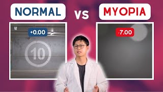 MYOPIA vs normal vision POV [upl. by Nazay]