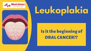 Leukoplakia l Precancerous lesions l Oral pathology l Mediklaas [upl. by Carita270]