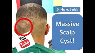 Massive cyst eruption LipomaCystcom Dr Khaled Sadek [upl. by Beniamino759]