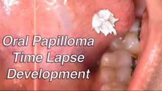 Oral Papilloma Development Time Lapse Oral Wart [upl. by Entruoc927]