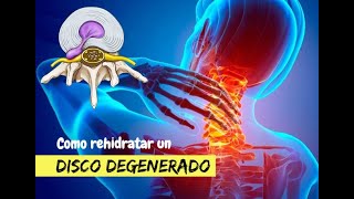 ¿Cómo rehidratar un disco degenerado [upl. by Parthenia70]