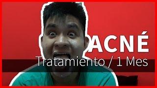 Tratamiento Acné  1 Mes  Doxiciclina  Experiencia [upl. by Nnylcaj63]