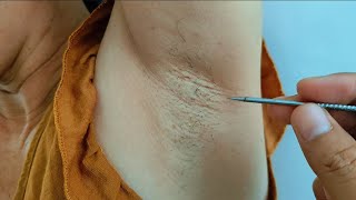 PLUCKING INGROWN UNDERARM HAIR and spit armpit hair for ms Kien asmr [upl. by Fitzpatrick]