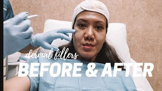 my first time dermal fillers under eyes and cheeks Restylane Philippines BEFORE amp AFTER [upl. by Vasiliki]