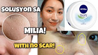 PAANO MAGTANGGAL NG MILIABUTLIG AT HOME Safe Easy amp Scar Free  FEAT Nivea Cream  ayaesguerra [upl. by Elman]