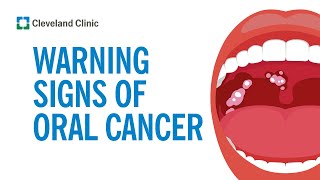 How to Screen Yourself for Oral Cancer [upl. by Ihp]