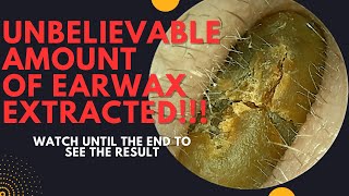 UNBELIEVABLE Amount Of Earwax Extracted From This Ear Watch Until The End [upl. by Andryc]