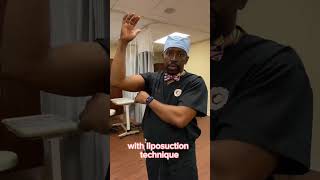 Scarless Arm Lift or Brachioplasty by Dr Okoro [upl. by Haim]