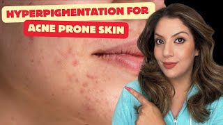 Effective Hyperpigmentation Treatment for Acne Prone Skin  Clear Your Skin Fast  Nipun Kapur [upl. by Red]