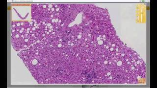 Approach to Liver Biopsy with Keith Kaplan MD [upl. by Wieche]