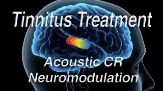 Tinnitus Treatment Using Acoustic Coordinated Reset Neuromodulation ACRN [upl. by Au]