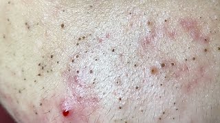 Acne Treatment Huong Da Nang The video has been lost for a long time Remove Blackheads [upl. by Nylanaj]