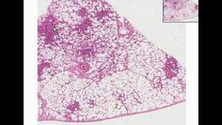 Histopathology LungBronchopneumonia [upl. by Athalie173]