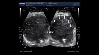 Ultrasound Video showing Hypoechoic splenic lesions [upl. by Cherianne24]