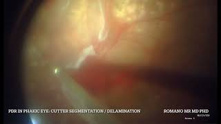 Tractional retinal detachment in PDR [upl. by Ruiz607]