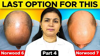 Norwood Grade 6 and 7 Hair Transplant Surgery  Full stepbystep Guide [upl. by Eilssel]