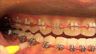 111 HOW TO USE MY INTERDENTAL TOOTHPICKS WITH BRACES ON [upl. by Laddy]