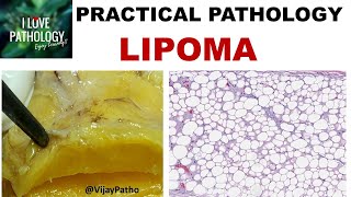 LIPOMA  Gross amp Microscopy Types and variants [upl. by Cuttler]