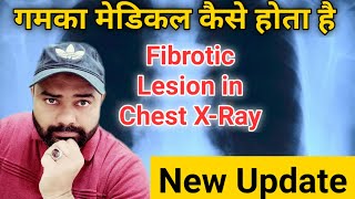 Fibrotic lesion in chest xray  Gamca medical kaise hota hai [upl. by Ehrenberg]