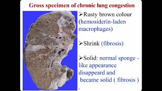 3 Hemodynamic Disorders 32 hyperemia and congestion [upl. by Kamat117]