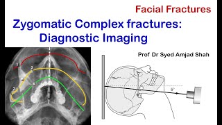 Diagnostic Imaging for Zygomatic Complex Fractures  Oral amp Maxillofacial Surgery  Syed Amjad Shah [upl. by Buell]