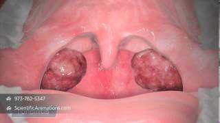 3D Medical Illustration of Tonsils  Tonsillitis Animation  ENT Animation [upl. by Nebra]