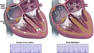 Atrial Fibrillation [upl. by Capon469]