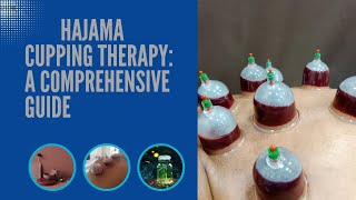 quotExploring Hijama Cupping Therapy A Comprehensive Guidephysiotherapy [upl. by Anoiuq709]