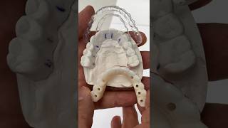 Clear Stent and PMMA dental teeth smile lsk121shorts shortvideo shorts implants implant [upl. by Teresina172]