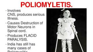 Polio Epidemiology [upl. by Willet]