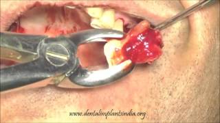 Distal maxillary dental implantation with one piece dental implants [upl. by Negriv577]