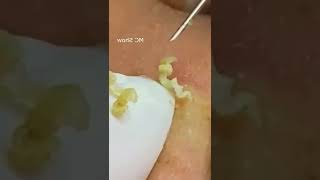 Pickel Ausdrücken Blackheads Akne amp Mitesser entfernen 🔴 7 [upl. by Retha]