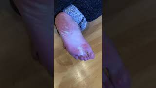 Dysautonomia blood pooling in feet [upl. by Ahsuat]