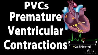 Premature Ventricular Contractions PVCs Animation [upl. by Akemahs]