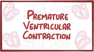 Premature Ventricular Contraction  causes symptoms diagnosis treatment pathology [upl. by Anitsyrhc]