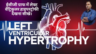 Left Ventricular Hypertrophy in Hindi  LVH ECG में देखना सीखे। [upl. by Ybor]