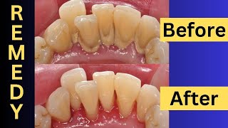 Naturally Remove Dental Plaque At Home Easy Tips And Tricks [upl. by Amberly]