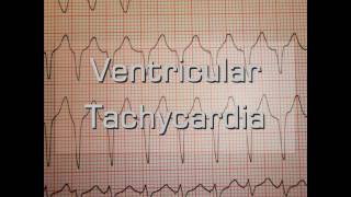 Ventricular Tachycardia [upl. by Llet]