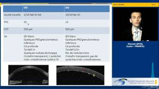 Hypertonie et uvéites  cas clinique Florent Aptel [upl. by Scharf]
