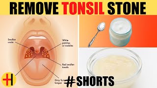 Powerful Home Remedies for Tonsil Stones That Work Fast  Tonsilloliths SHORTS [upl. by Odette]