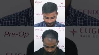 Hair Transplant Before After Your transplanted hair is permanent [upl. by Sayres]