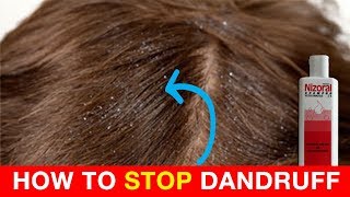 How To Get Rid Of Dandruff  Nizoral Shampoo Experience [upl. by Raclima22]