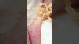 Pickel Ausdrücken Blackheads Mitesser entfernen 🔴 50 [upl. by Naehgem]