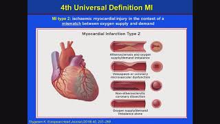 How to manage myocardial infarction with nonobstructive coronary arteries MINOCA [upl. by Vastha623]