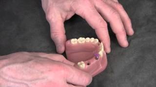 Straumann Implant Level Impressions [upl. by Yesdnik810]