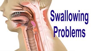 Swallowing Problems or Dysphagia Top 4 Possible Causes Including Cricopharyngeal Dysfunction CPD [upl. by Leoine]