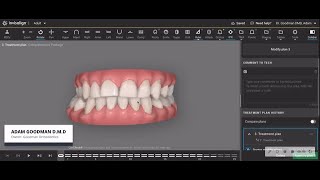 The unforeseen consequences of removing four premolars for orthodontic treatment [upl. by Rausch885]