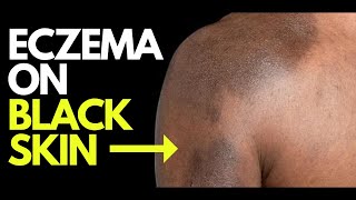 Doctor explains what ECZEMA looks like on BLACK SKIN  plus photos diagnosis and treatment [upl. by Bilak38]